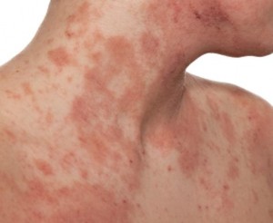 在香港每五個人便有一個人在不同時期患有濕疹。 濕疹是皮膚的表層炎症，引起痕癢，水泡，紅腫，並有滲出液，皮膚乾燥帶皮屑脫落。